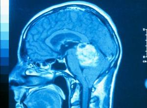 Первые симптомы злокачественной опухоли головного мозга у детей и взрослых