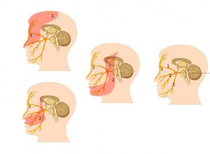Какими способами лечат воспаление тройничного нерва?