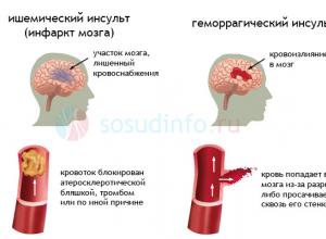Инсульт мозжечка (мозжечковый инсульт): причины, симптомы, восстановление, прогноз