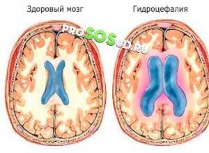Как проходит лечение гидроцефалии головного мозга