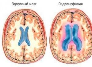 Внутренняя асимметричная гидроцефалия мозга