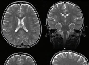 Наружная заместительная гидроцефалия головного мозга — виды, фото и лечение болезни