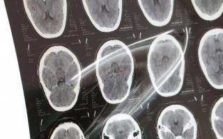 Признаки рака головного мозга: это важно знать каждому!