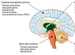 Опухоль мозжечка: симптомы, диагностика и лечение