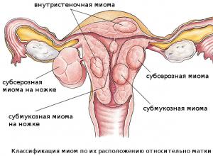 Фибромиома матки: симптомы и признаки, лечение, беременность Лечение узловой миомы матки
